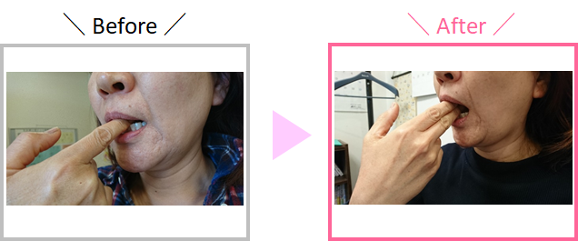M.Sさんの顎の開き具合の変化を示している画像
